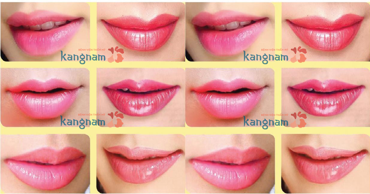 phun môi tại bệnh viện thẩm mỹ Kangnam ảnh2